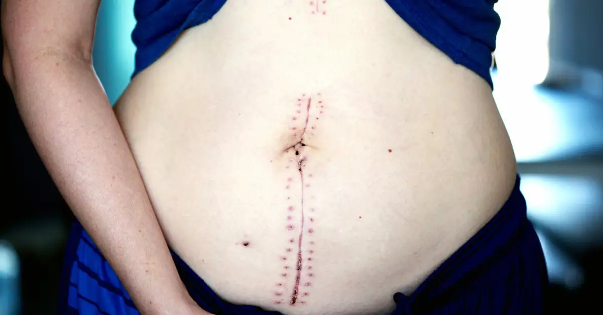 Comment éliminer l'accumulation de liquide abdominal post-op ?