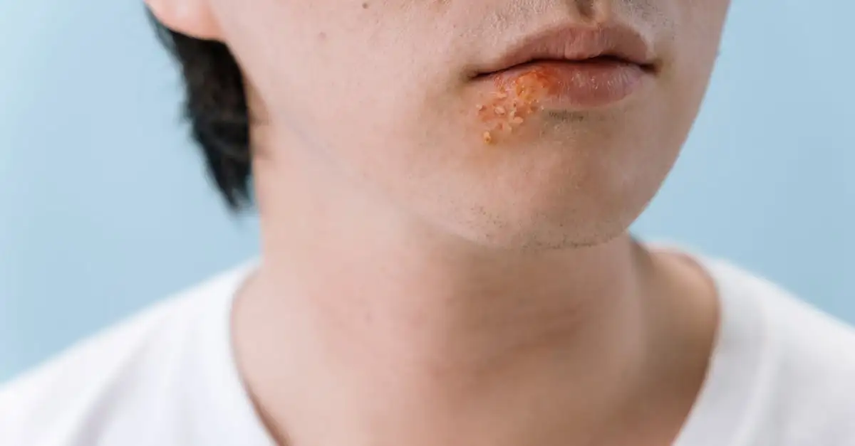 Comment reconnaître une morsure d'araignée ?
